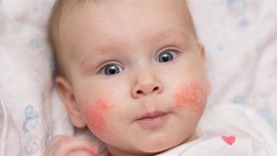 كيف تحمين طفلك من الحساسية الغذائية 