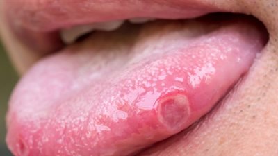 طبيبة توضح الأسباب الرئيسية لسرطان اللسان