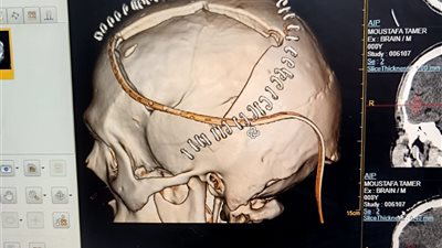  جراحة دقيقة تنقذ مريضًا بعد إصابة بالغة في المخ بــ