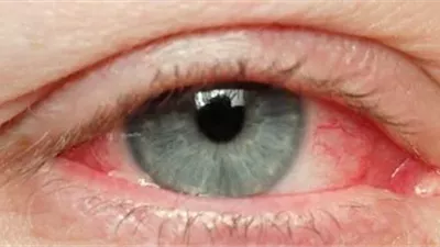 انتبه.. أعراض لـ 