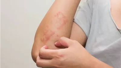 طبيبة تحذر.. مشكلات يشير إليها الطفح الجلدي