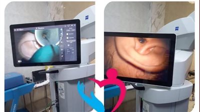 إجراء عملية جراحية دقيقة لاستئصال ورم بالمخ وقاع الجمجمة لشاب بمستشفى العامرية بغرب الاسكندرية 