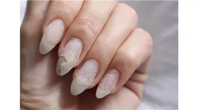 الأسباب الشائعة لتشوه الأظافر وطرق علاجه والوقاية منه