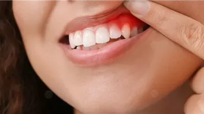 التهاب اللثة قد يصيبك بأمراض خطيرة.. طبيبة تحذر