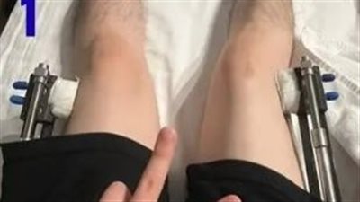 عمليات تطويل الساقين.. مخاطر عديدة ونقاهة طويلة من أجل 10سم