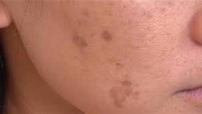 الأسباب الهرمونية لظهور البقع الصبغية على الوجه.. طرق العلاج الحديثة