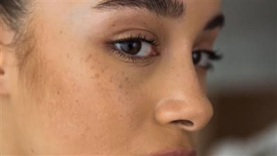 البقع الصبغية على الوجه.. الأسباب الهرمونية وطرق العلاج الحديثة
