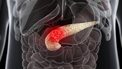 تجنبها.. عادة شائعة تؤدي إلى الإصابة بسرطان البنكرياس