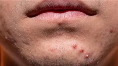 4 علامات تشير إلى زيادة مستويات هرمون التستوستيرون