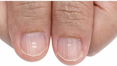 10 علامات على انخفاض مستويات الحديد في جسمك