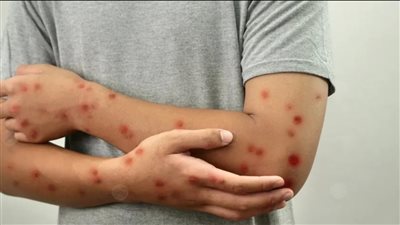 المراكز الأفريقية: عدد الإصابة بجدري القرود في أفريقيا تجاوز 190 ألف حالة منذ بداية عام 2024