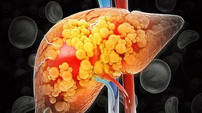 دراسة حديثة تكشف ثلاثية قاتلة تهدد صحة الكبد لدى واحد من كل 5 أشخاص