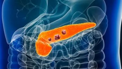 عدم تنظيف أسنانك يهددك بمرض خطير