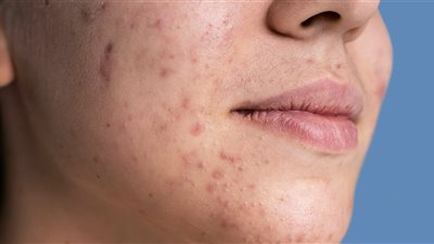 باحثون يطورون لقاحين لعلاج حب الشباب ومنع ظهوره