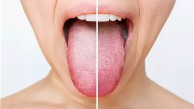 مستويات الحديد: أعراض على لسانك تشير إلى نقصه