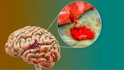 نتائج صادمة.. ارتفاع حالات 