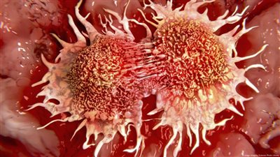 نتائج صادمة.. الوفيات بالسرطان قد ترتفع إلى 18.5 مليون حالة سنويا بحلول 2050