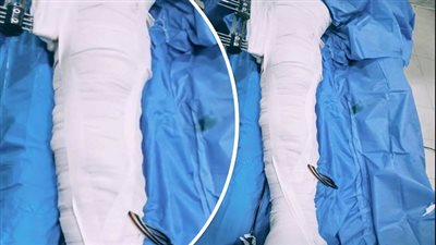 صبي يعود للحياة بعد جراحة عظام معقدة بالشرقية