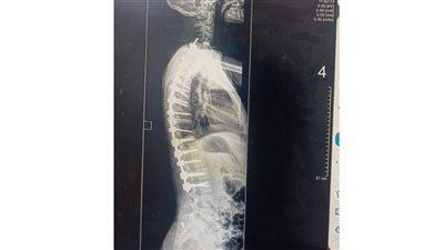 نجاح جراحة دقيقة بالعمود الفقري لطفلة بمستشفى جامعة القناة