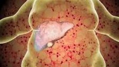 علاج جديد يقلل الالتهاب وتراكم الدهون في الكبد