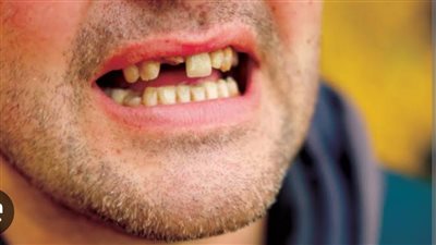فقدان الأسنان قد يكون نذير شؤم.. ما دلالته؟