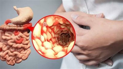 5 أعراض تسبب التهابًا في الأمعاء.. تجاهلها يؤدي إلى مشكلة أكبر