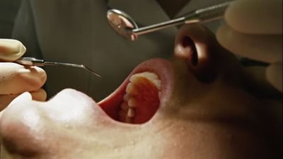 دراسة جديدة: صحة الأسنان السبب الخفي وراء خطر السكتة الدماغية