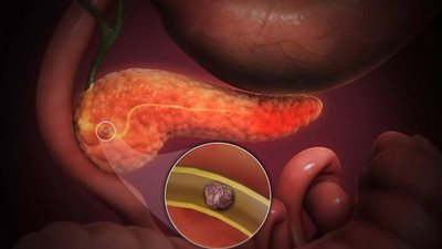 باحثون يطورون اختبار تنفس ثوري يكشف سرطان البنكرياس مبكرا