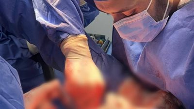 إجراء أول عملية تركيب مفصل فخذ كامل لمريض بمستشفى القنطرة شرق