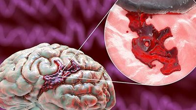 أسباب ارتفاع الجلطات الدماغية بين الشباب.. طرق الوقاية