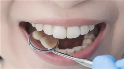 علماء يبتكرون هلام يصلح الأسنان التالفة دون جراحة