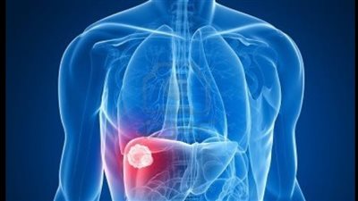 باحثون يحذرون.. مكون شائع في حياتنا اليومية مرتبط بتليف وسرطان الكبد