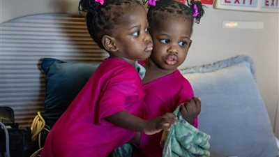 نجاح عملية فصل توأم سيامي جامايكي في عملية دامت 5 ساعات بالسعودية 