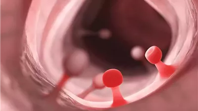 الأطعمة فائقة المعالجة تعزز نمو الزوائد المعوية الممهدة للسرطان (تفاصيل)