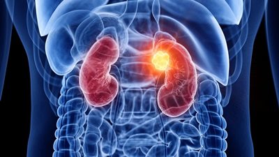 مكون في أدوية التخسيس يقدم فائدة مدهشة لمرضى الفشل الكلوي.. علماء يوضحون