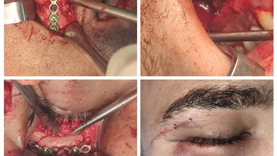 نجاح جراحة  لإصلاح كسر معقّد بمنتصف الوجه بمستشفى شربين المركزي 