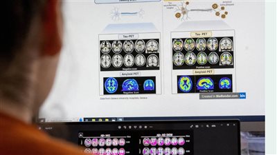 اختراق علمي قد يوقف مرض «ألزهايمر» قبل بدايته