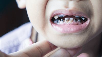 طبيبة تحذر من مخاطر تسوس أسنان الأطفال اللبنية