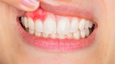 طبيبة أسنان تحذر.. أعراض في الفم قد تخفي مشاكل صحية