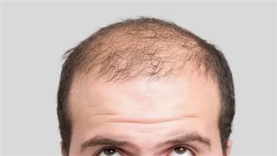 آثار خطيرة لدواء شائع يعالج الصلع لدى الرجال.. ما القصة؟