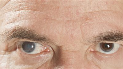 طبيب يكشف السبب الأساسي لإعتام عدسة العين