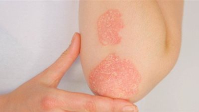 أمراض جلدية تتفاقم في الخريف والشتاء.. تعرف عليها
