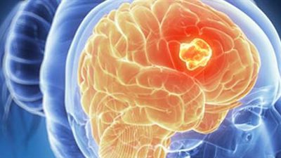 دواء شائع يمكنه محاربة أحد أخطر أنواع سرطان المخ.. علماء يكشقون التفاصيل