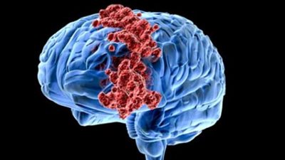 علماء يطورون طريقة قد تعالج أحد أخطر أورام الدماغ (تفاصيل)