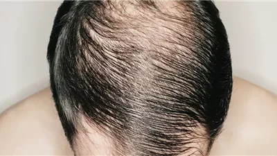 علماء يتوصلون إلى علاج ثوري يظهر نتائج مذهلة في استعادة الشعر المفقود