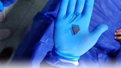 استخراج بطارية ودبوس.. إنقاذ حياة ثلاثة أطفال بمستشفى أبو كبير