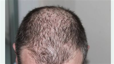 تجارب سريرية تكشف عن فاعلية عالية لعلاج جديد للصلع