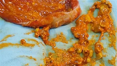 نجاح أول عملية لاستخراج حصوات بالقناة المرارية داخل مستشفيات صحة الدقهلية