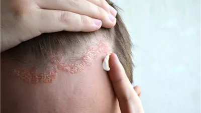 علماء يتوصلون لـ آلية جديدة تساهم في تطور الصدفية