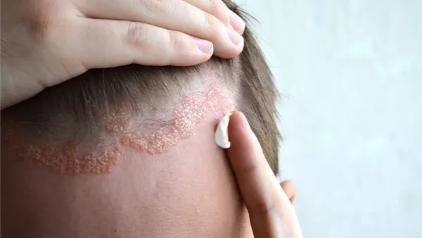 علماء يتوصلون لـ آلية جديدة تساهم في تطور الصدفية